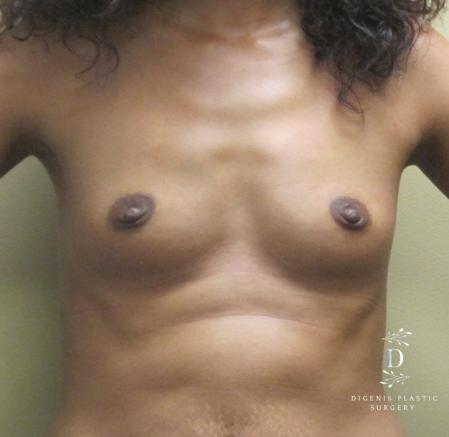 Breast Augmentation: Patient 14 - Before 1