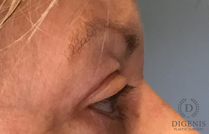 Eyelid Surgery: Patient 77 - After 3