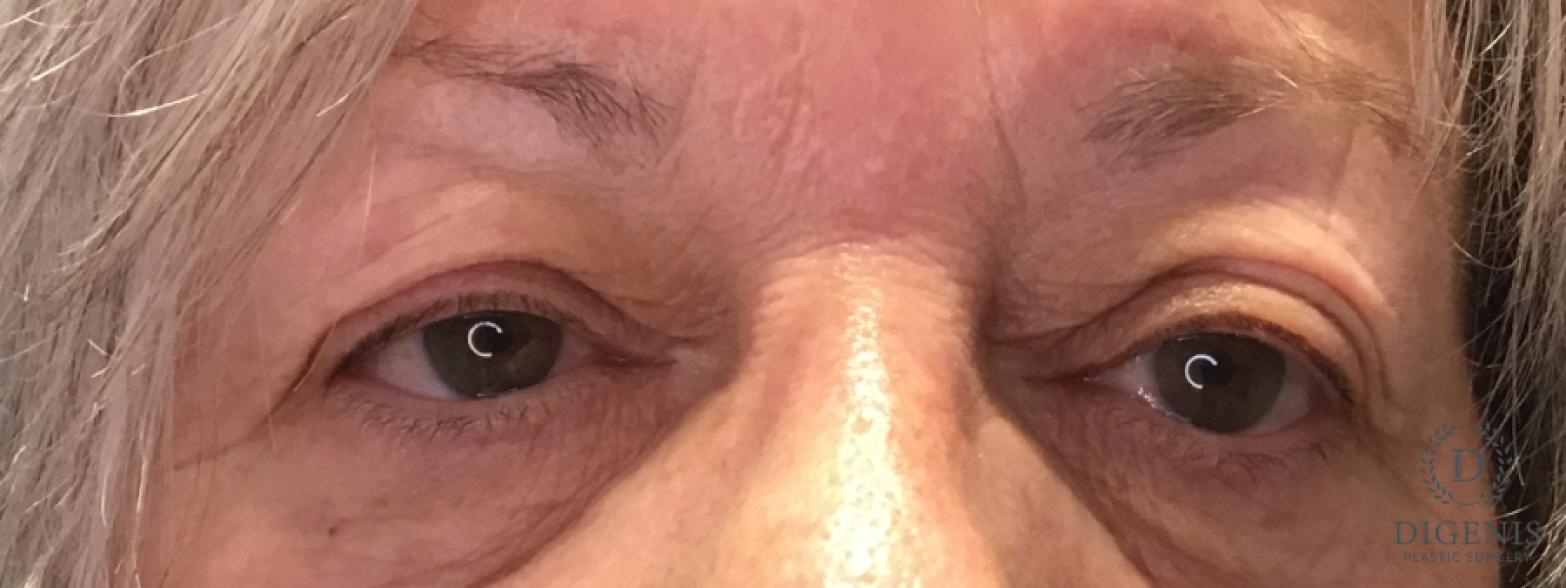 Eyelid Surgery: Patient 77 - Before 1