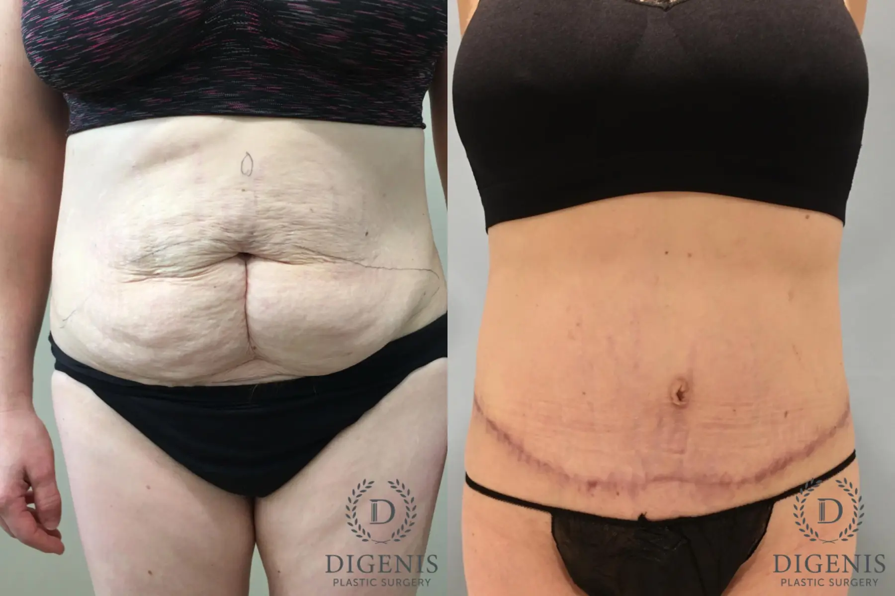 Abdominoplasty: Patient 27 - Before and After  