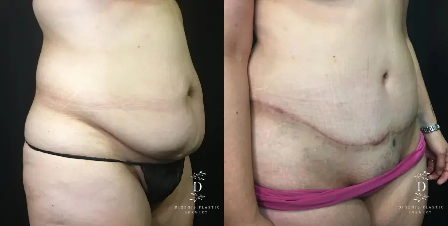 Abdominoplasty: Patient 11 - Before and After 2
