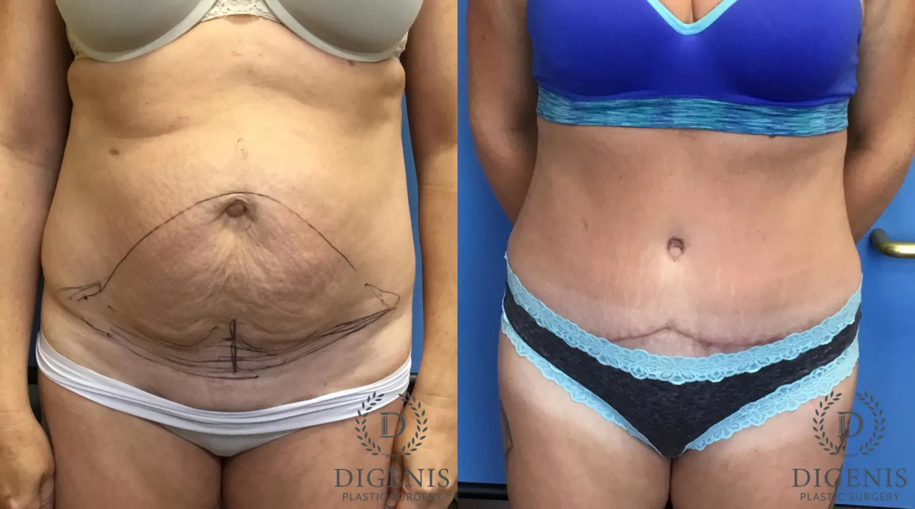 Abdominoplasty: Patient 3 - Before and After  