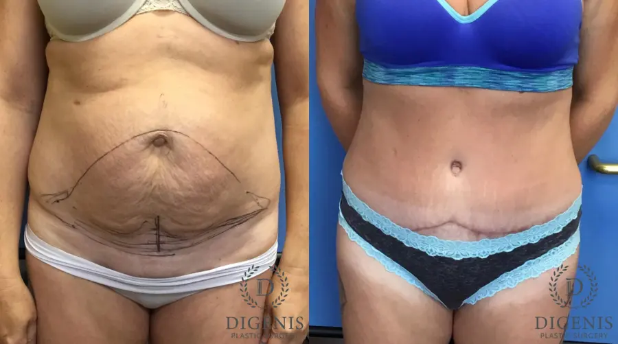 Abdominoplasty: Patient 3 - Before and After 1