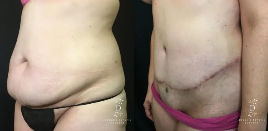 Abdominoplasty: Patient 11 - Before and After 4