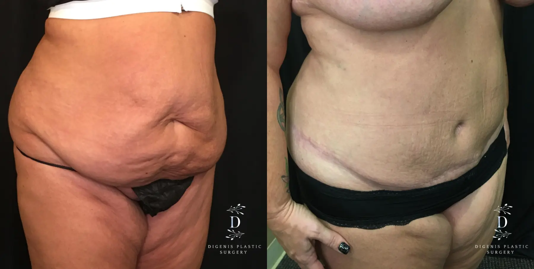 Abdominoplasty: Patient 8 - Before and After 2