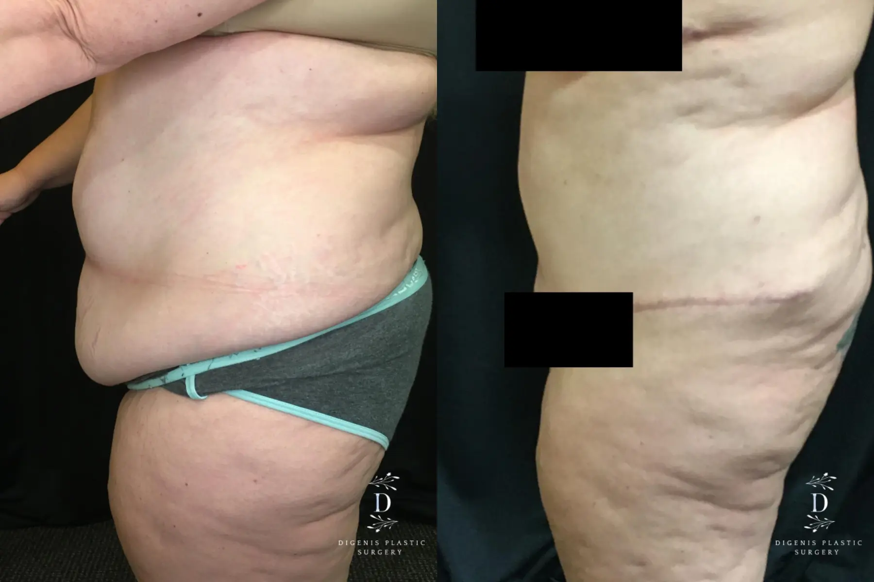 Abdominoplasty: Patient 14 - Before and After 5