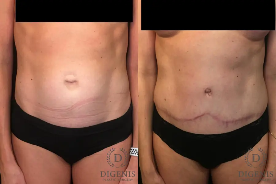 Abdominoplasty: Patient 1 - Before and After  
