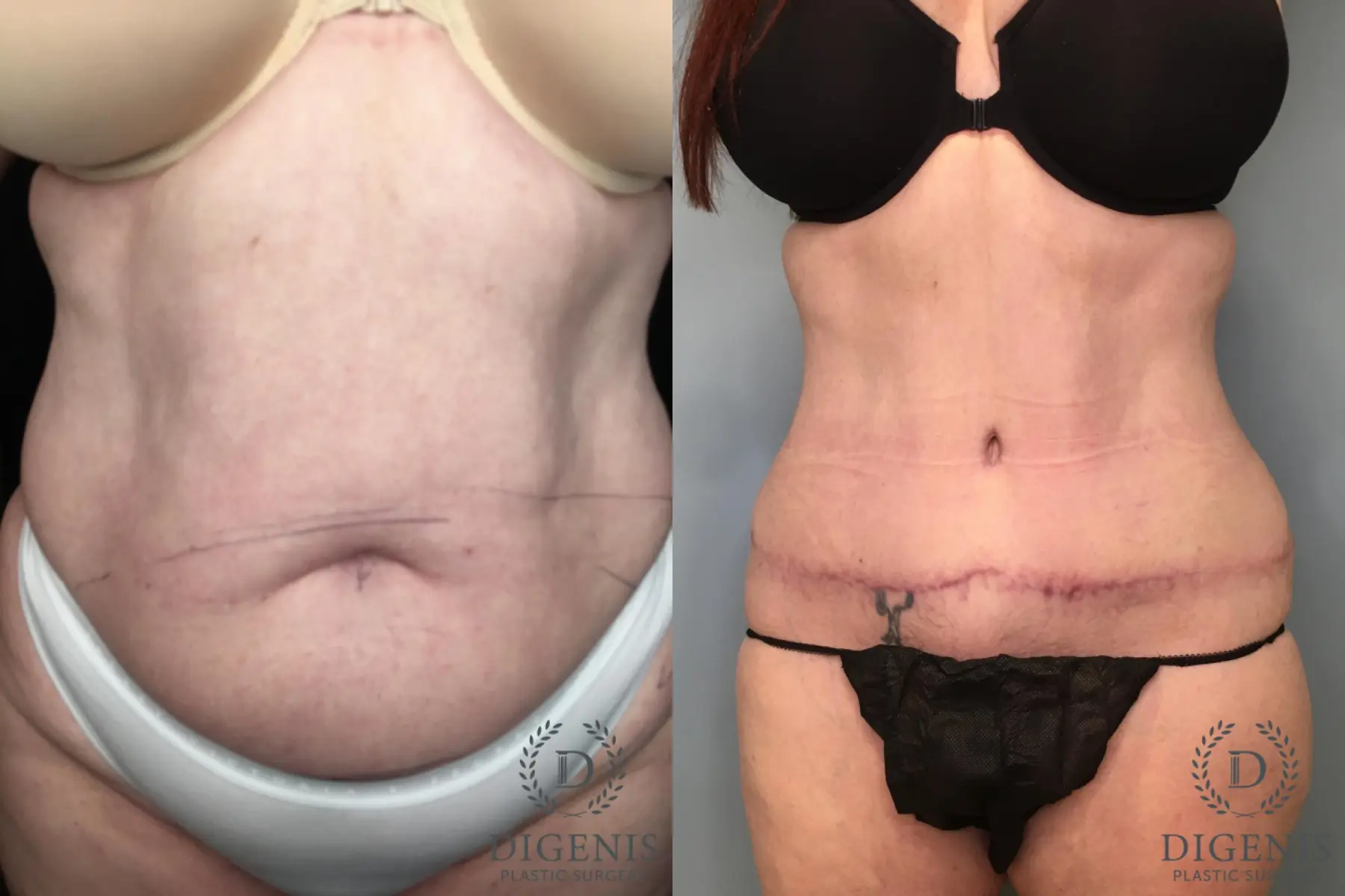 Abdominoplasty: Patient 23 - Before and After  