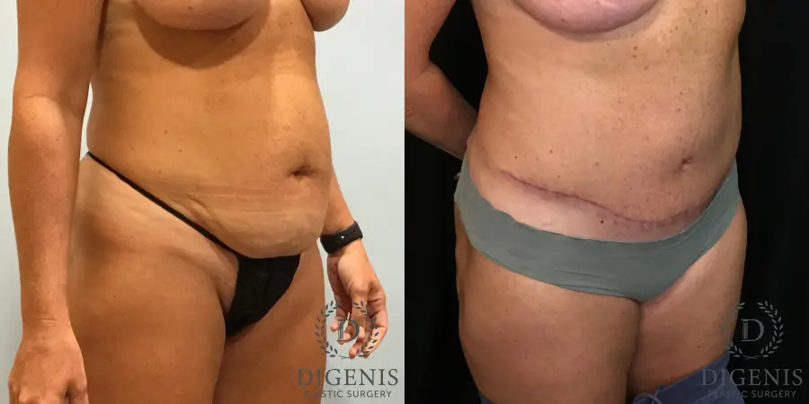 Abdominoplasty: Patient 4 - Before and After 2