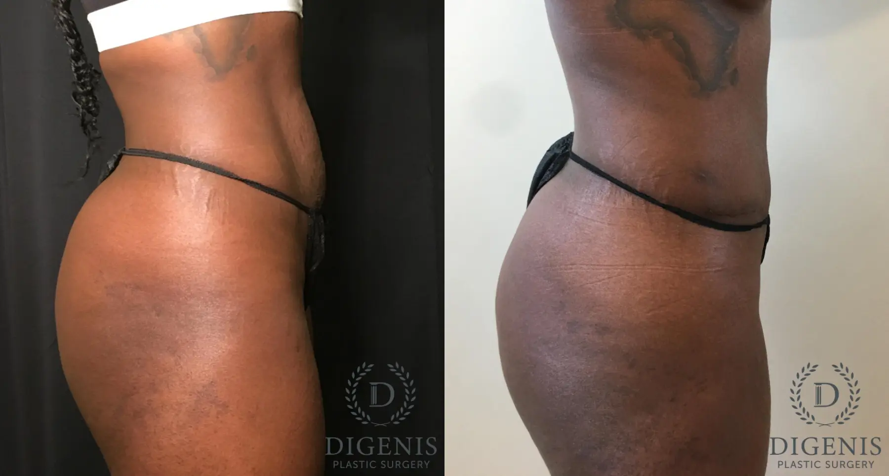 Abdominoplasty: Patient 18 - Before and After 3