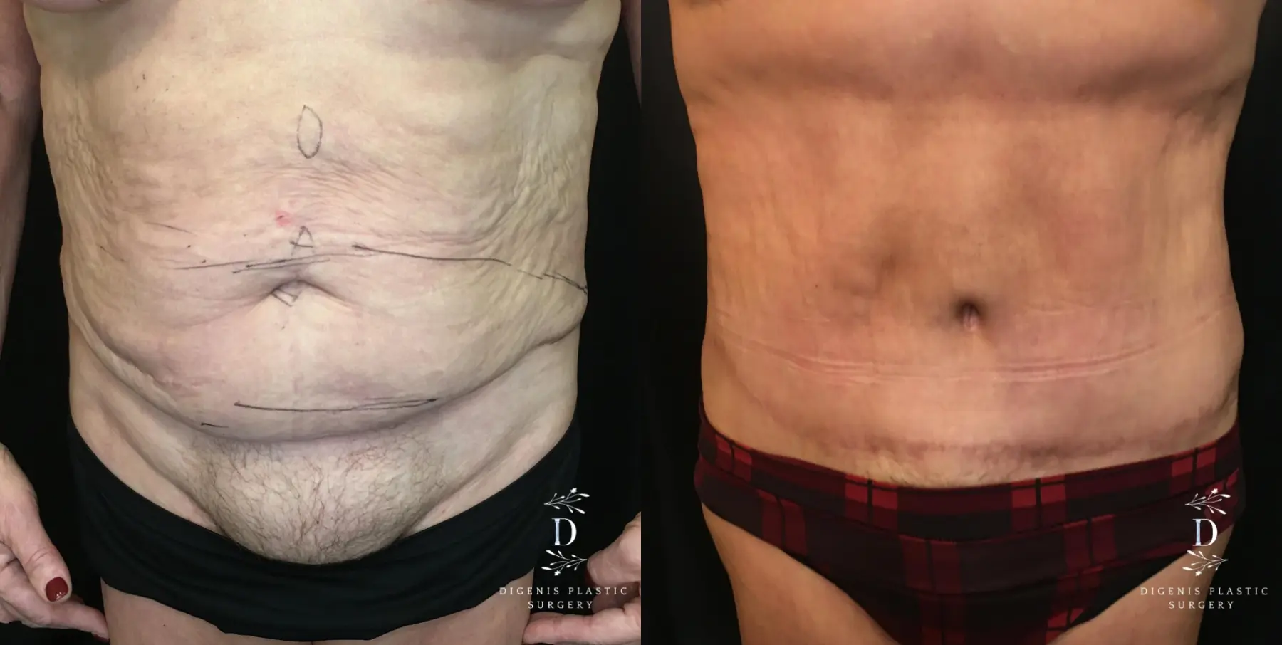 Abdominoplasty: Patient 10 - Before and After 1