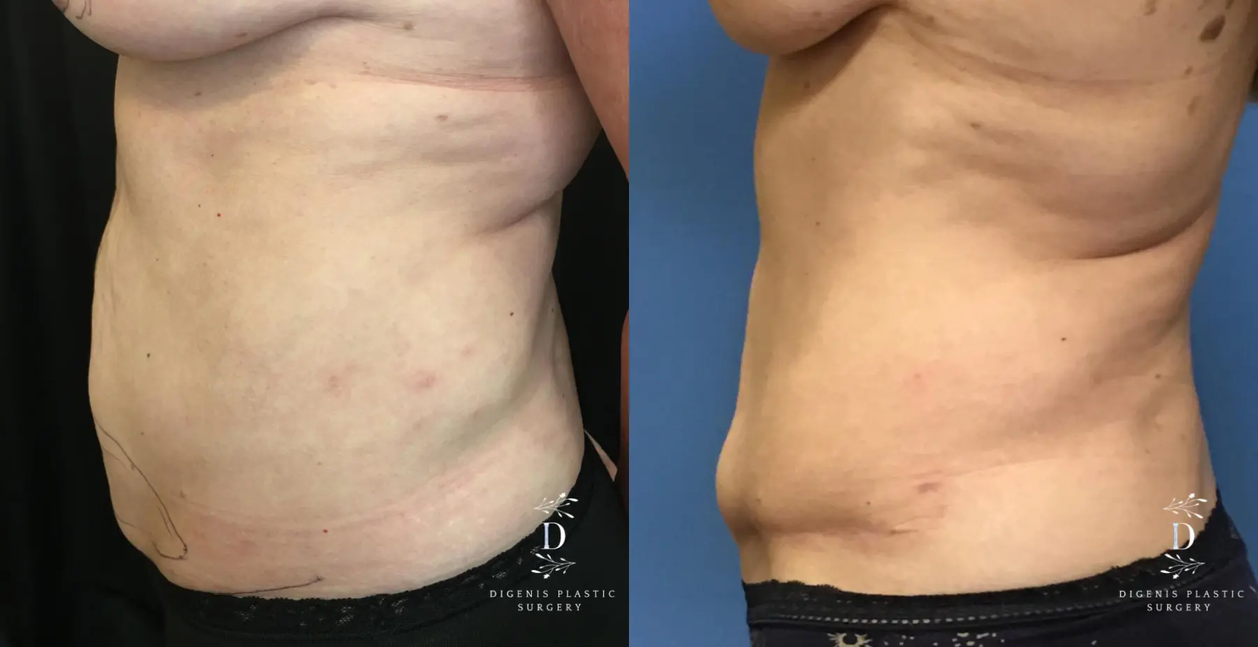 Abdominoplasty: Patient 16 - Before and After 5