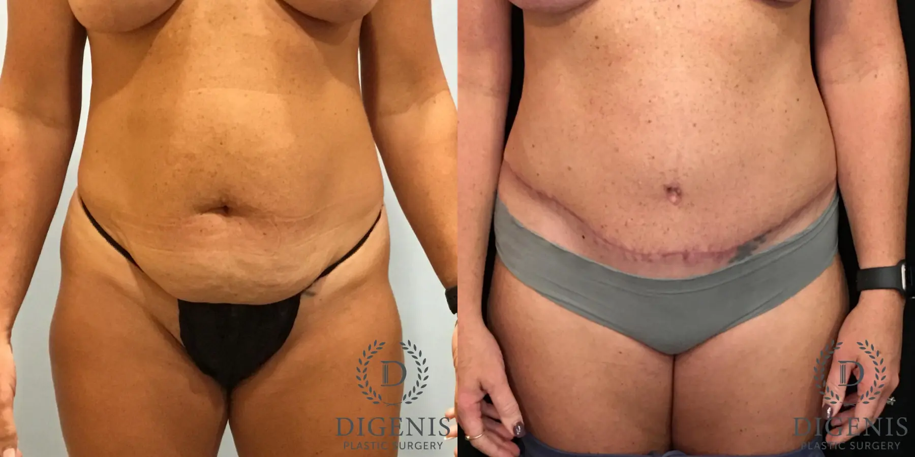 Abdominoplasty: Patient 4 - Before and After 1