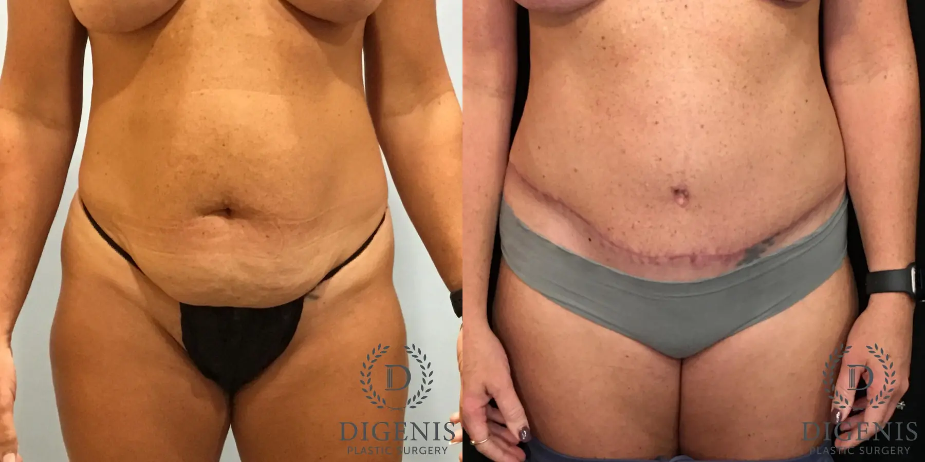 Abdominoplasty: Patient 4 - Before and After  