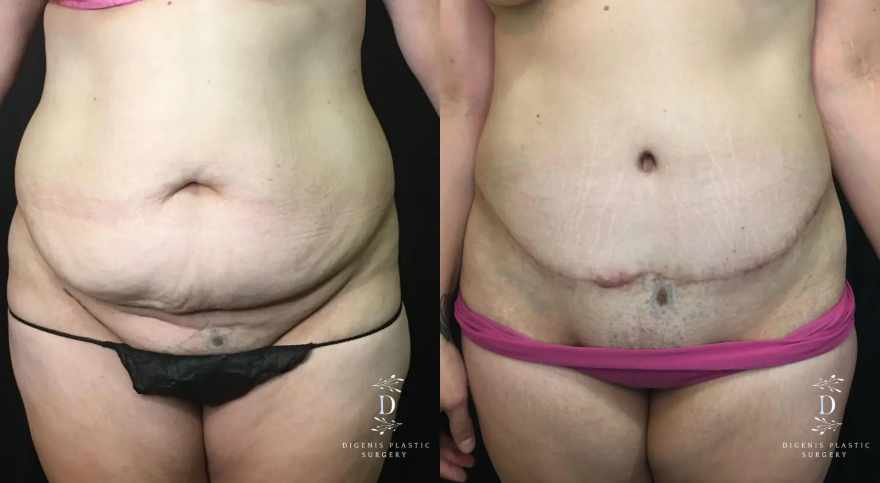 Abdominoplasty: Patient 11 - Before and After 1