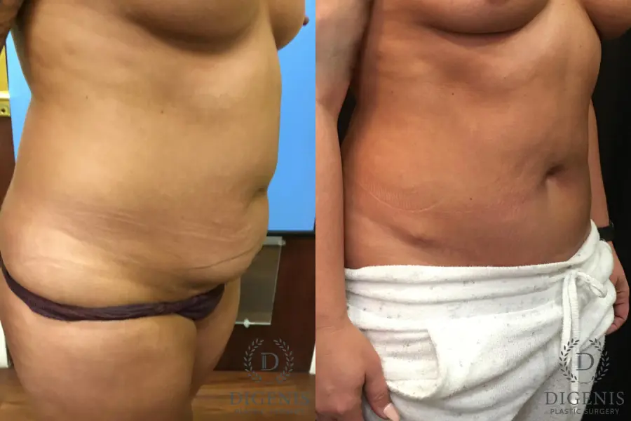 Abdominoplasty: Patient 2 - Before and After 2
