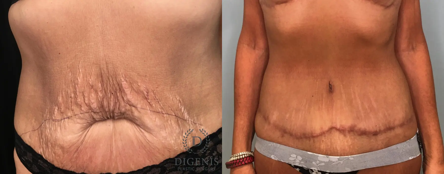 Abdominoplasty: Patient 20 - Before and After 1