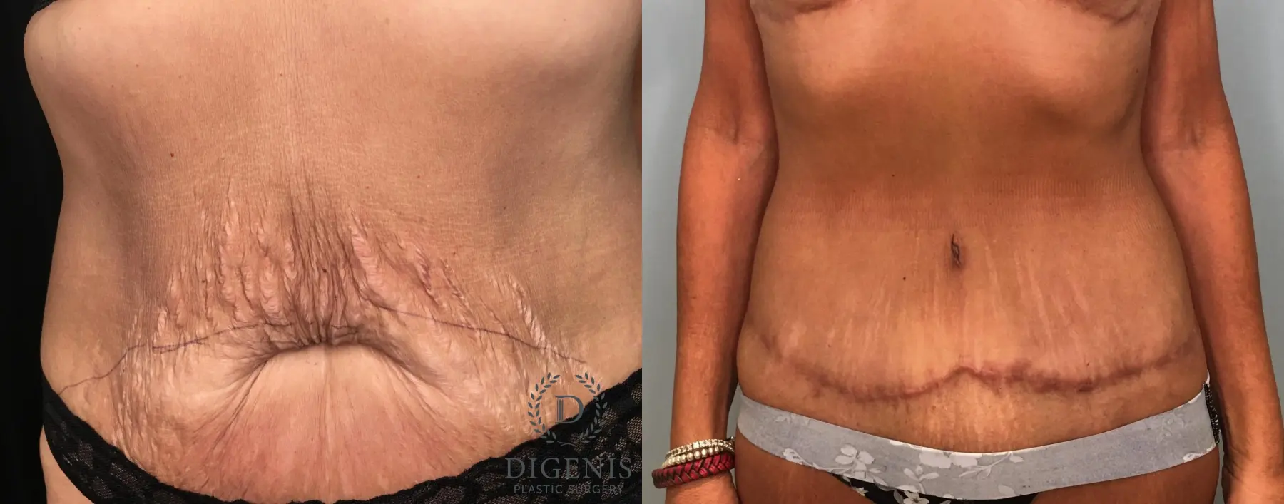 Abdominoplasty: Patient 21 - Before and After  