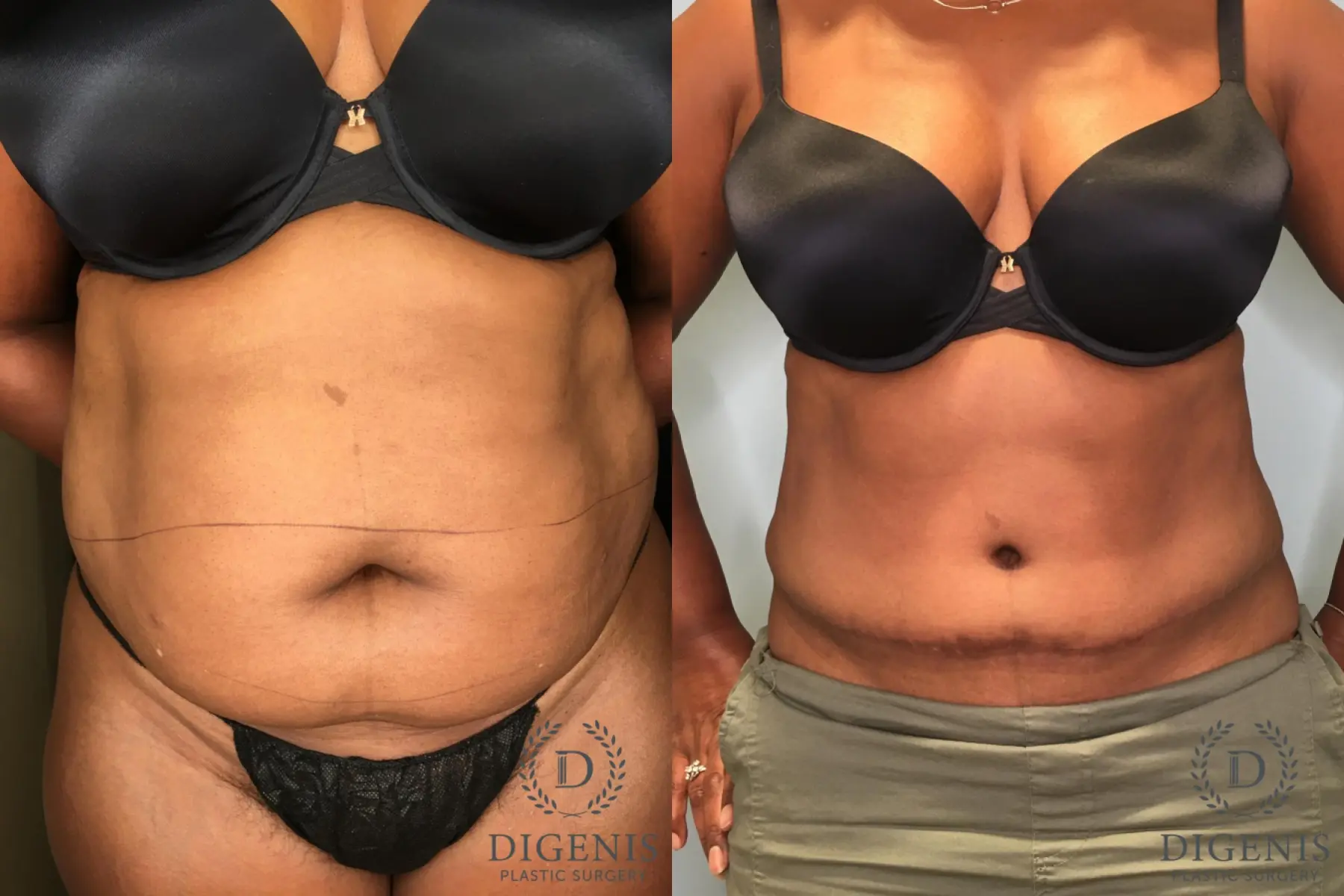 Abdominoplasty: Patient 20 - Before and After  