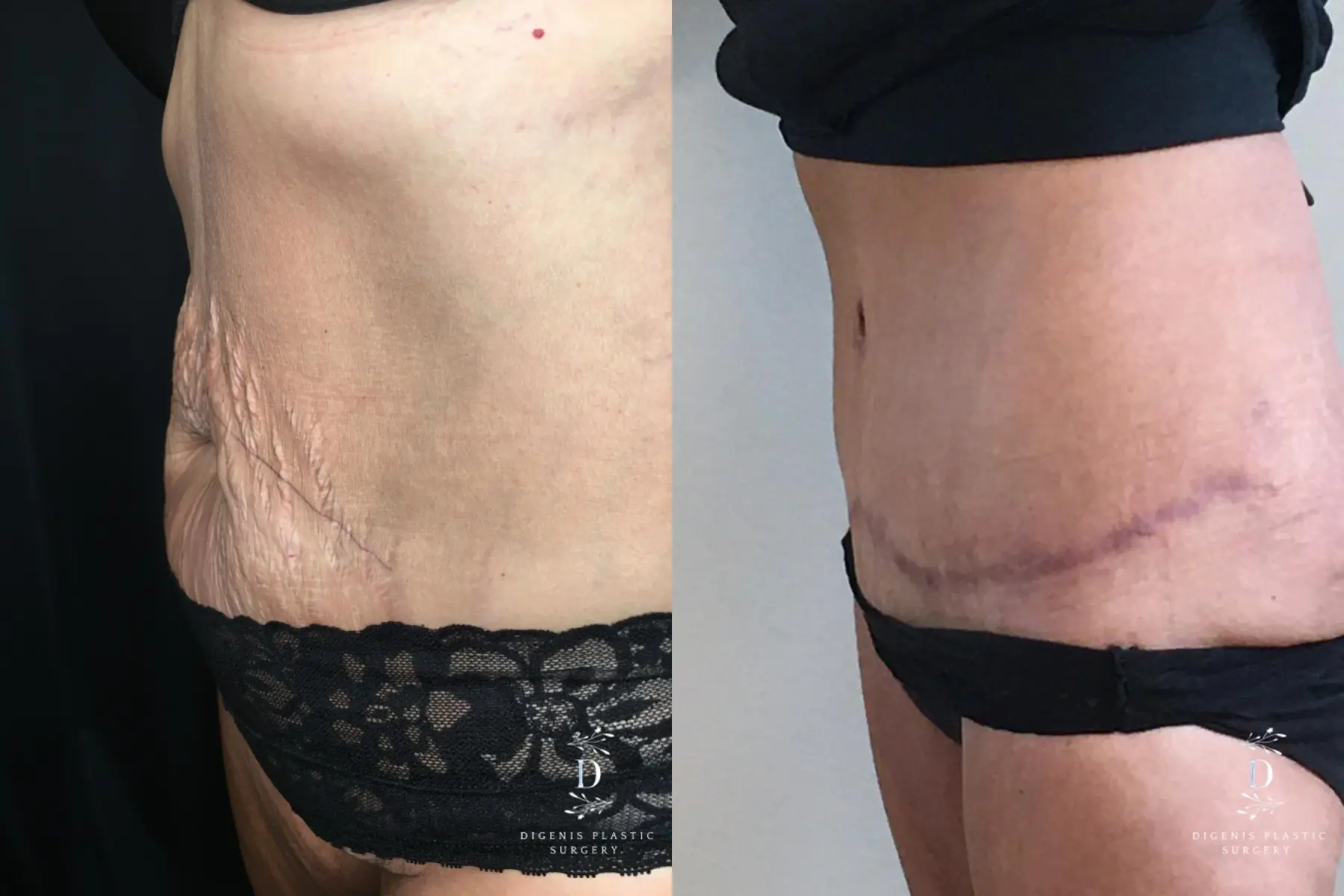 Abdominoplasty: Patient 17 - Before and After 4