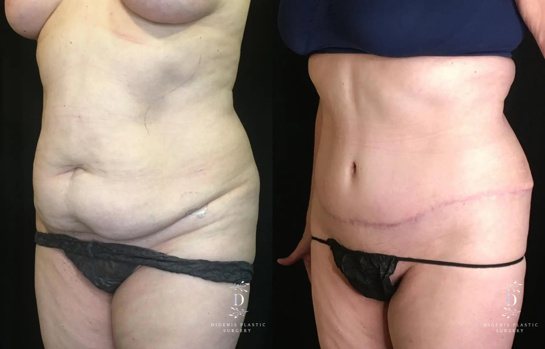 Abdominoplasty: Patient 15 - Before and After 4