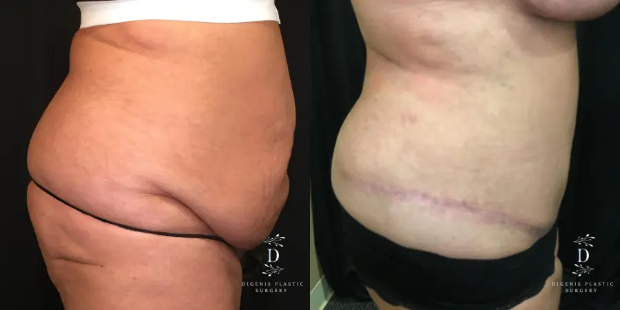 Abdominoplasty: Patient 7 - Before and After 3