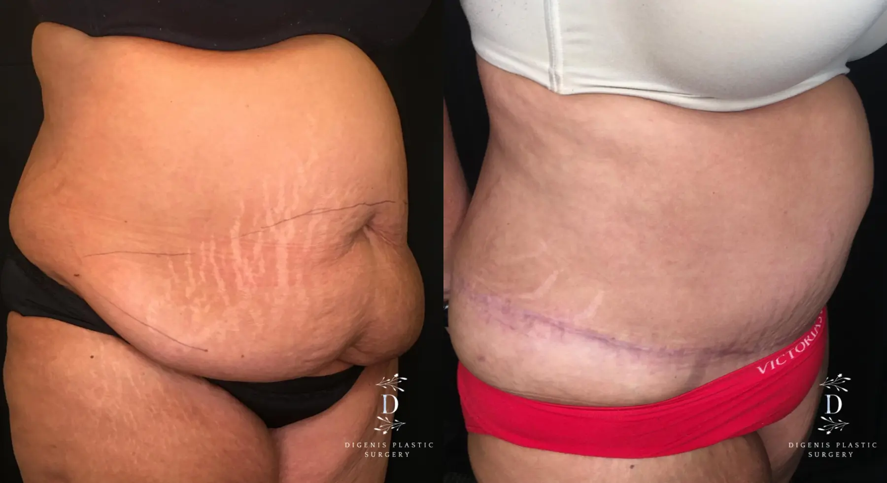 Abdominoplasty: Patient 13 - Before and After 2