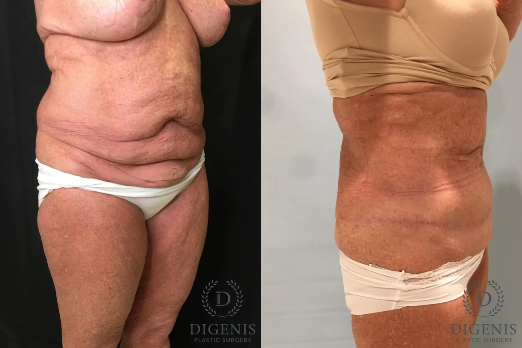 Abdominoplasty: Patient 23 - Before and After 4