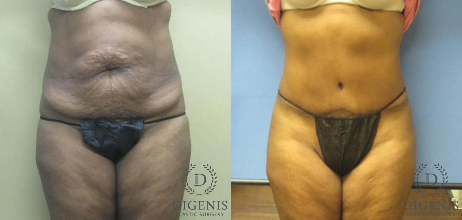 Abdominoplasty: Patient 5 - Before and After  