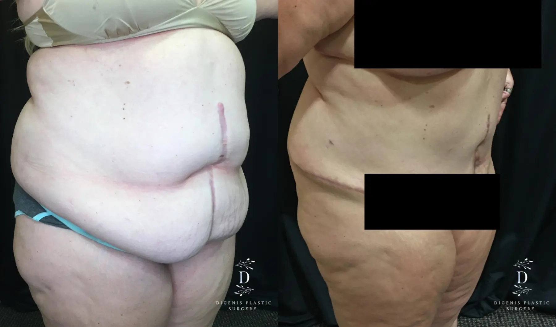 Abdominoplasty: Patient 14 - Before and After 2