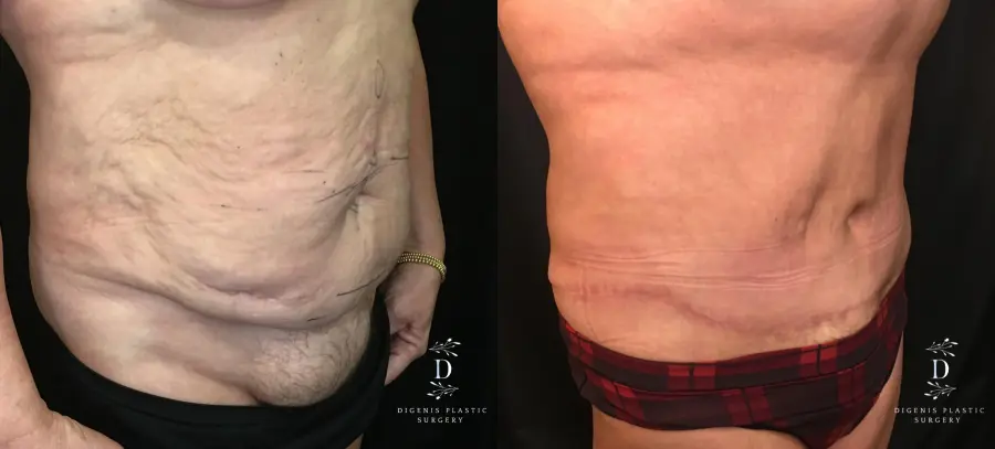 Abdominoplasty: Patient 10 - Before and After 2