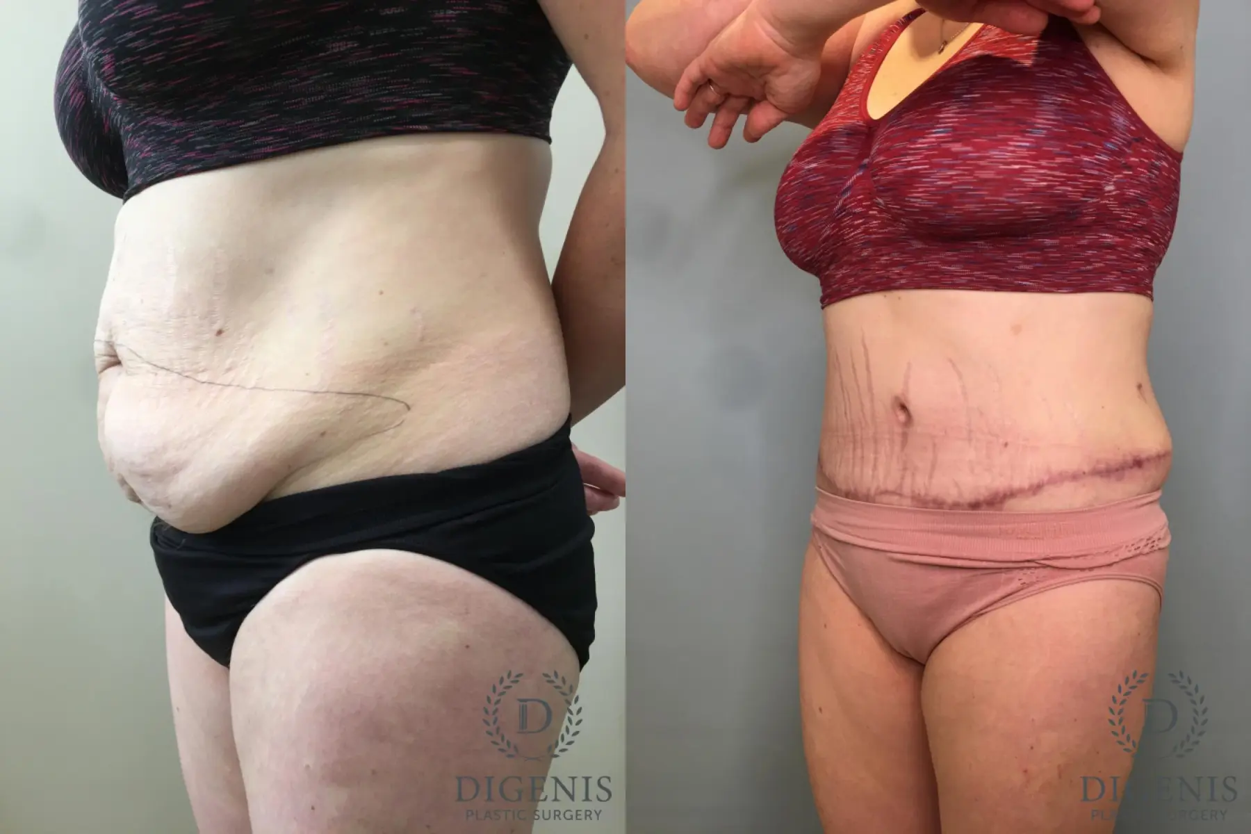 Abdominoplasty: Patient 21 - Before and After 4