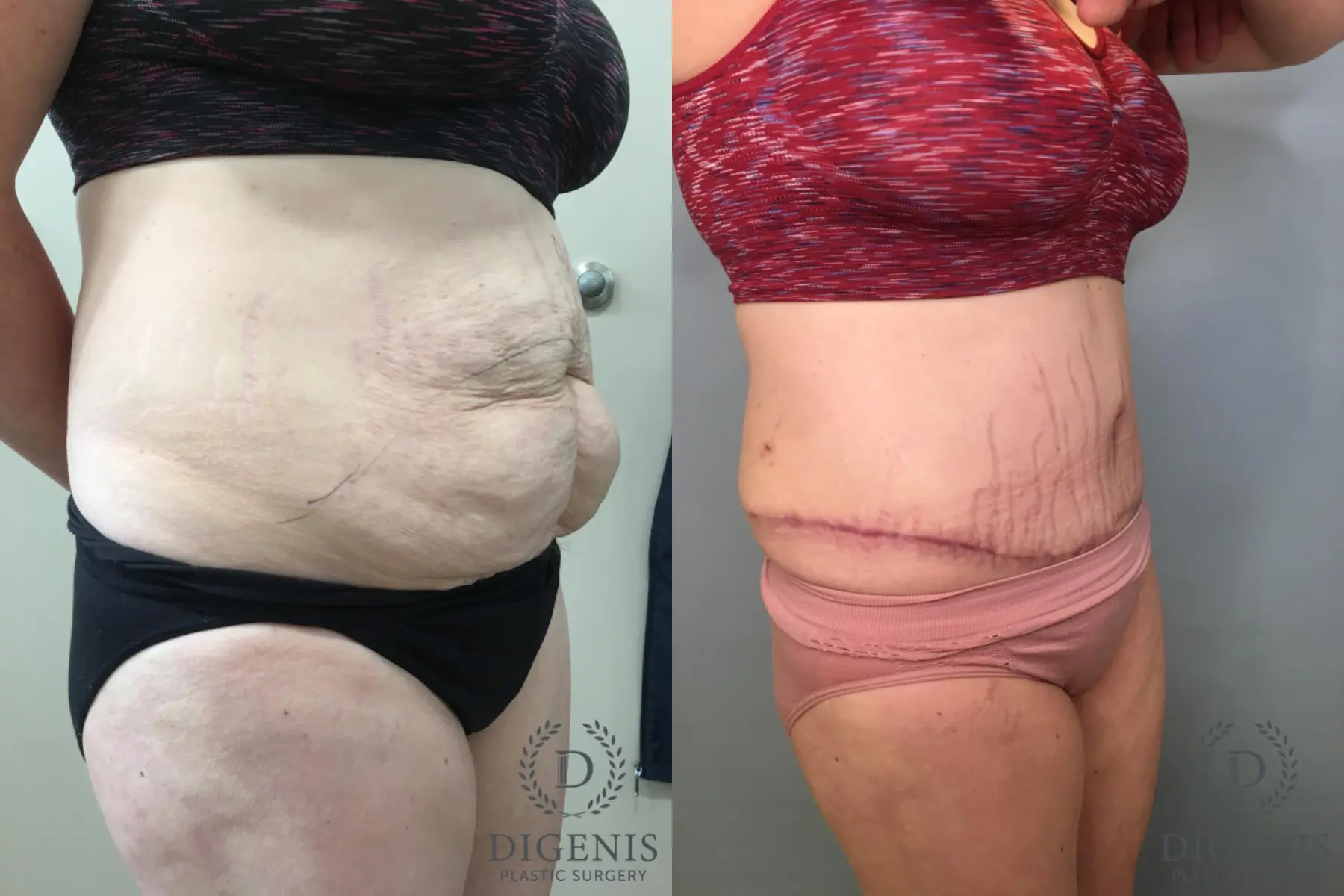 Abdominoplasty: Patient 21 - Before and After 2