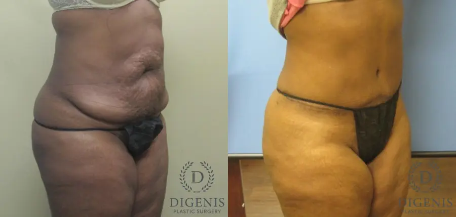 Abdominoplasty: Patient 5 - Before and After 2