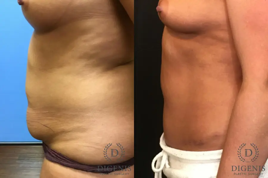 Abdominoplasty: Patient 2 - Before and After 5