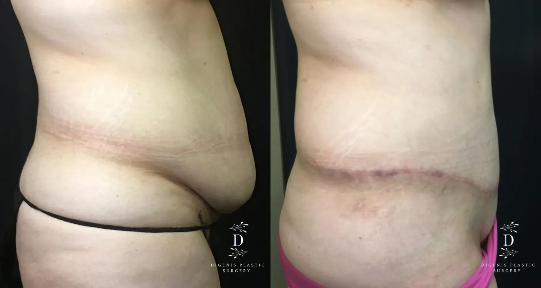 Abdominoplasty: Patient 11 - Before and After 3