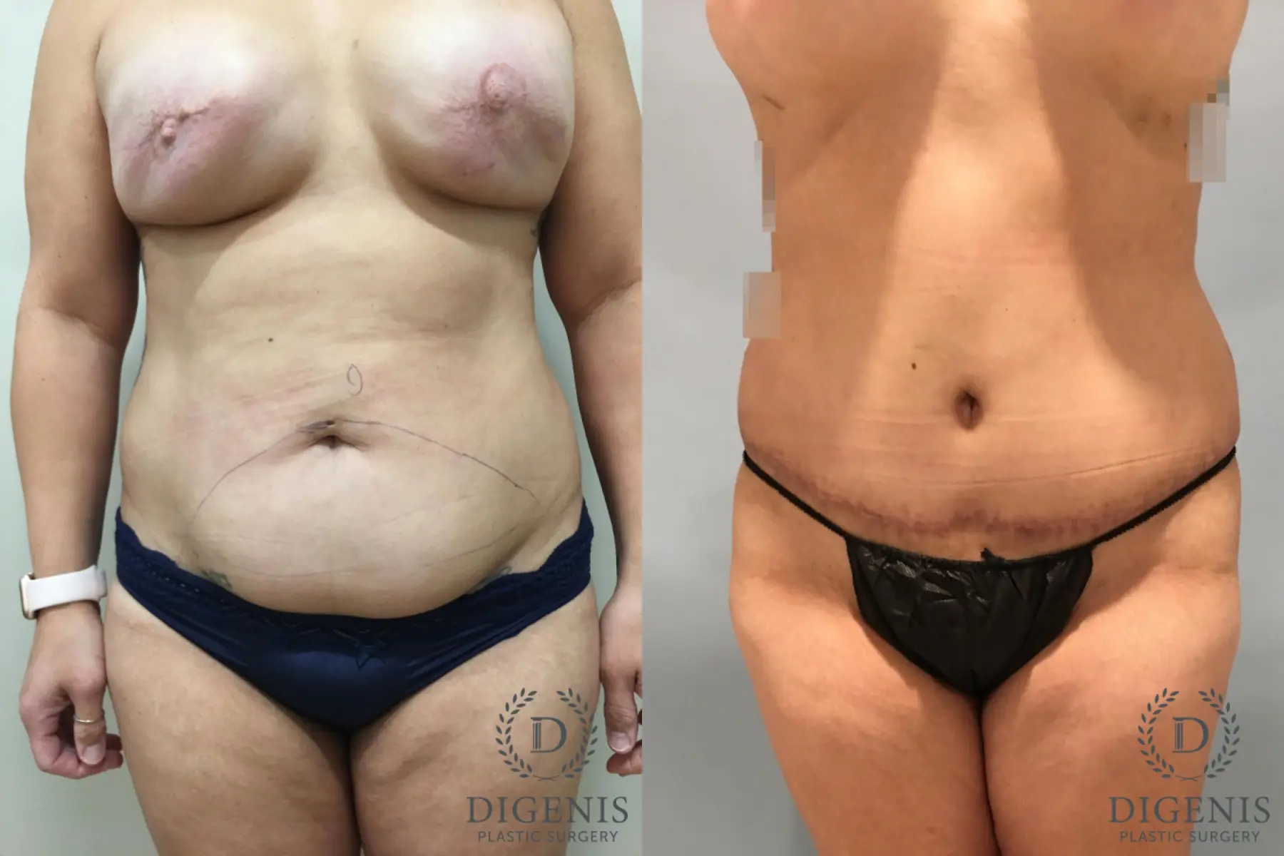 Abdominoplasty: Patient 24 - Before and After  