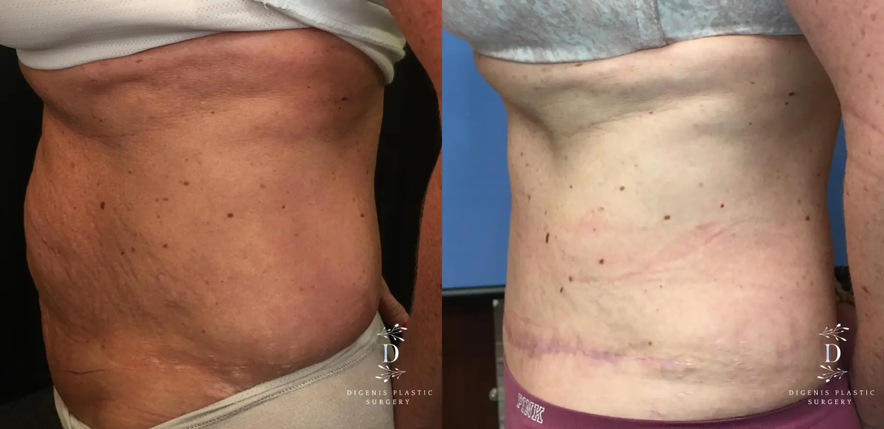 Abdominoplasty: Patient 12 - Before and After 5