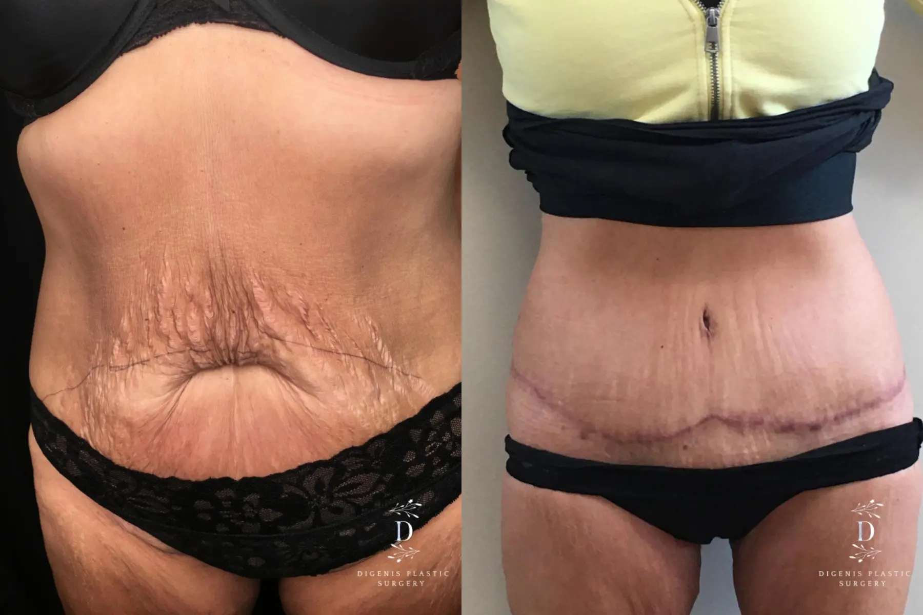 Abdominoplasty: Patient 18 - Before and After  