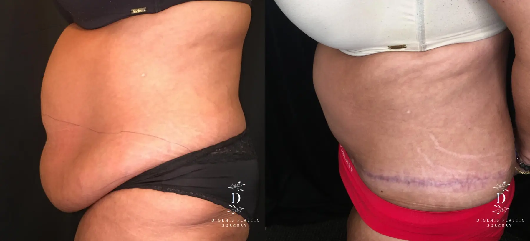 Abdominoplasty: Patient 13 - Before and After 5