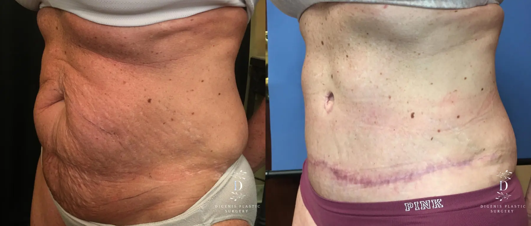 Abdominoplasty: Patient 12 - Before and After 4