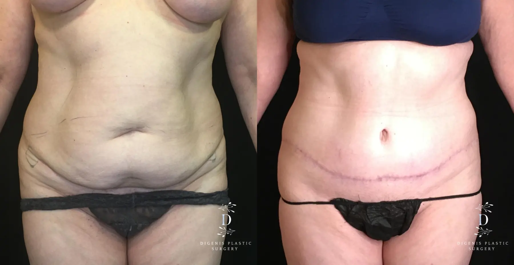 Abdominoplasty: Patient 15 - Before and After 1