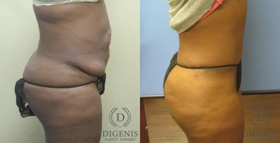 Abdominoplasty: Patient 5 - Before and After 3