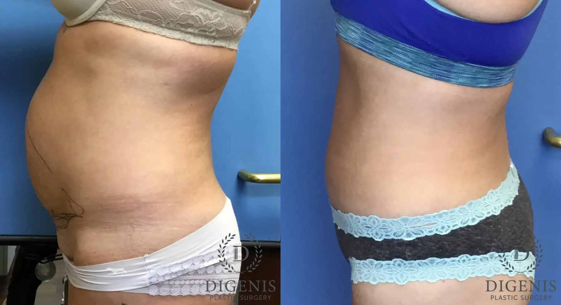Abdominoplasty: Patient 3 - Before and After 4