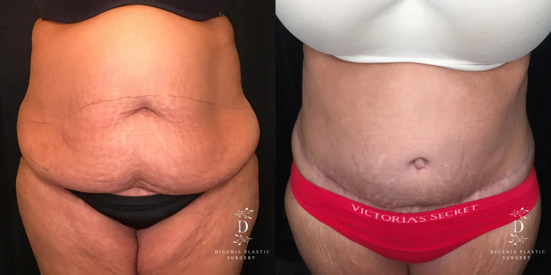 Abdominoplasty: Patient 14 - Before and After  