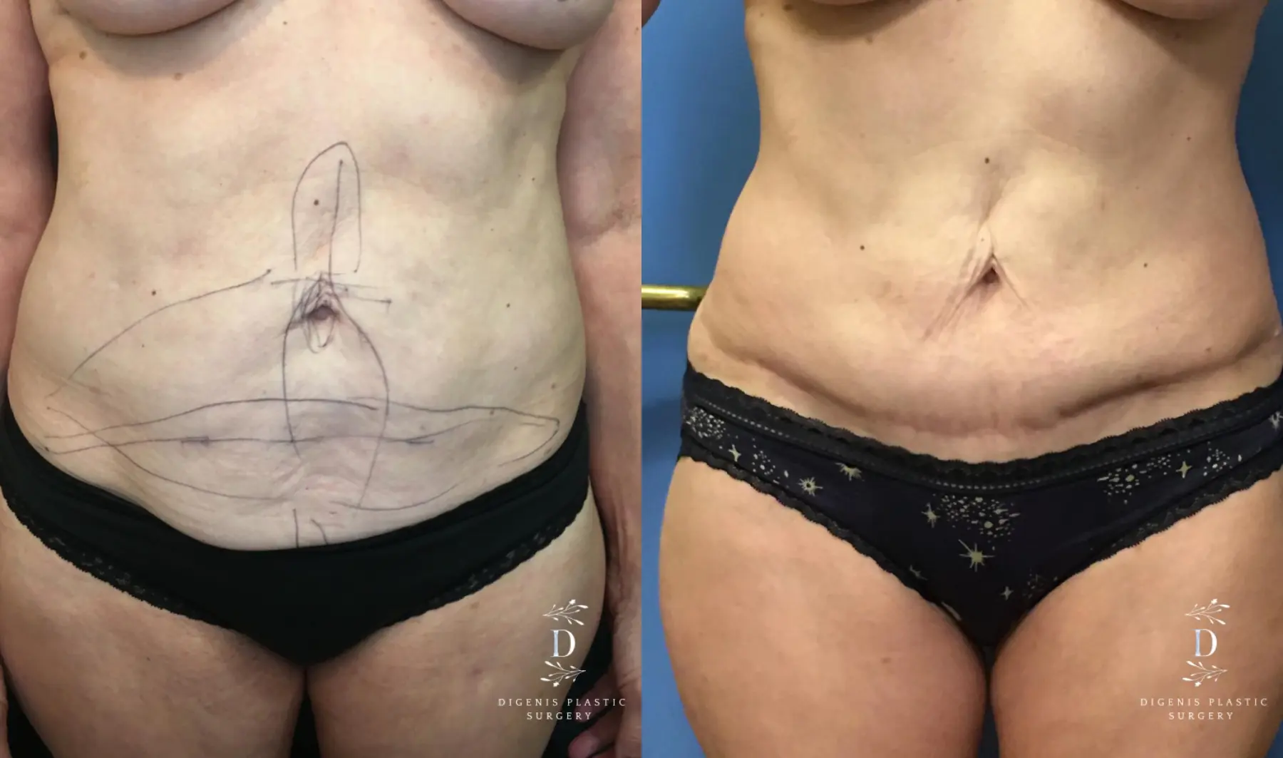 Abdominoplasty: Patient 16 - Before and After 1