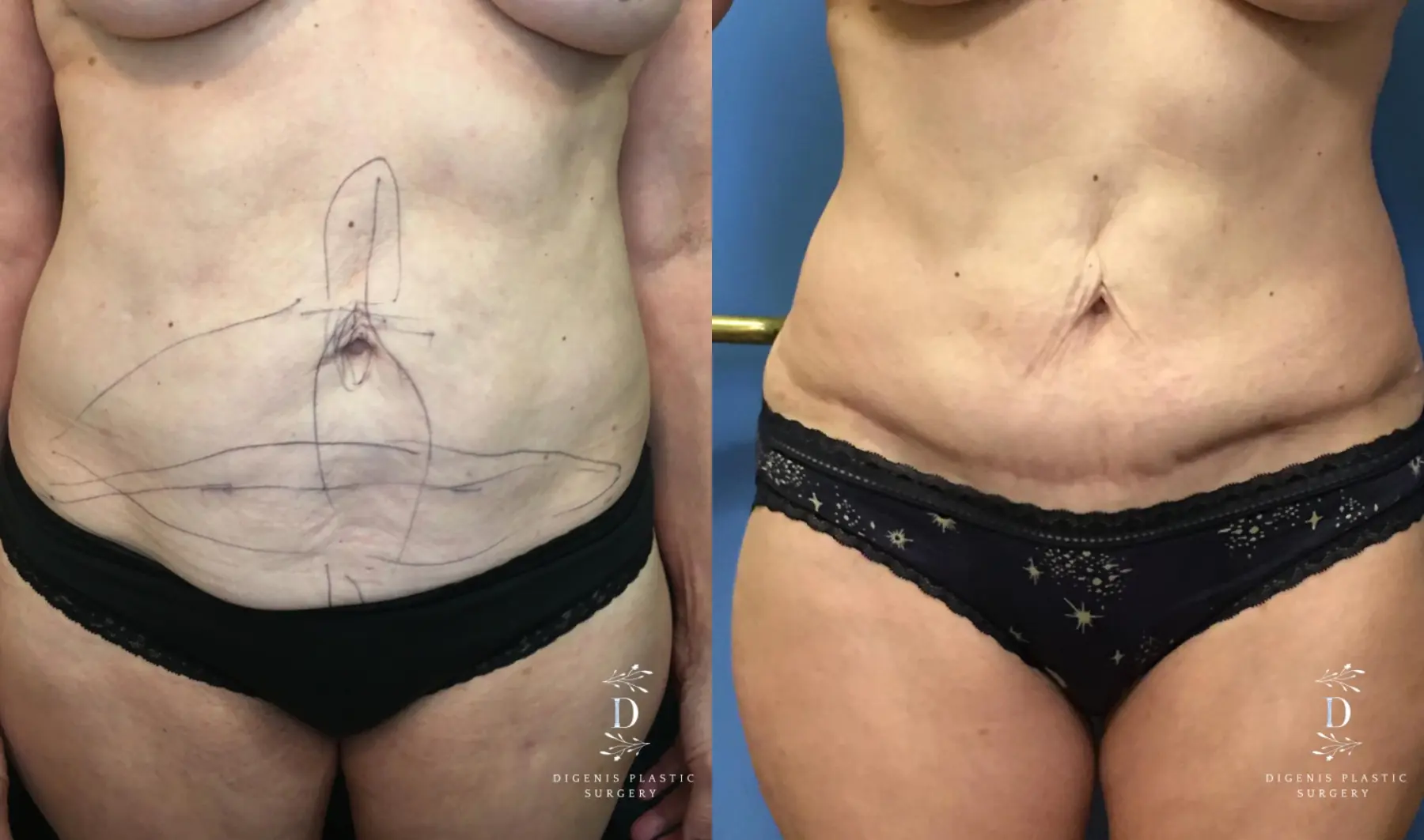 Abdominoplasty: Patient 17 - Before and After  