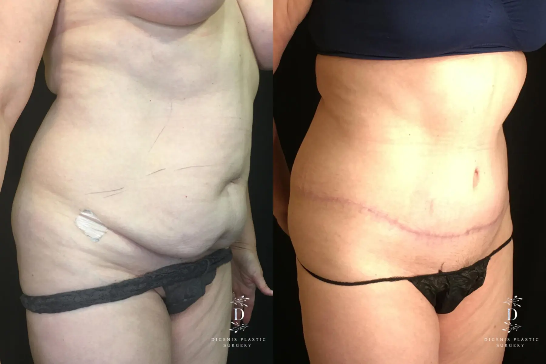Abdominoplasty: Patient 15 - Before and After 2