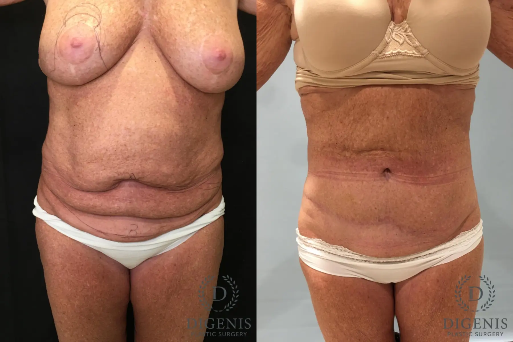 Abdominoplasty: Patient 23 - Before and After 1
