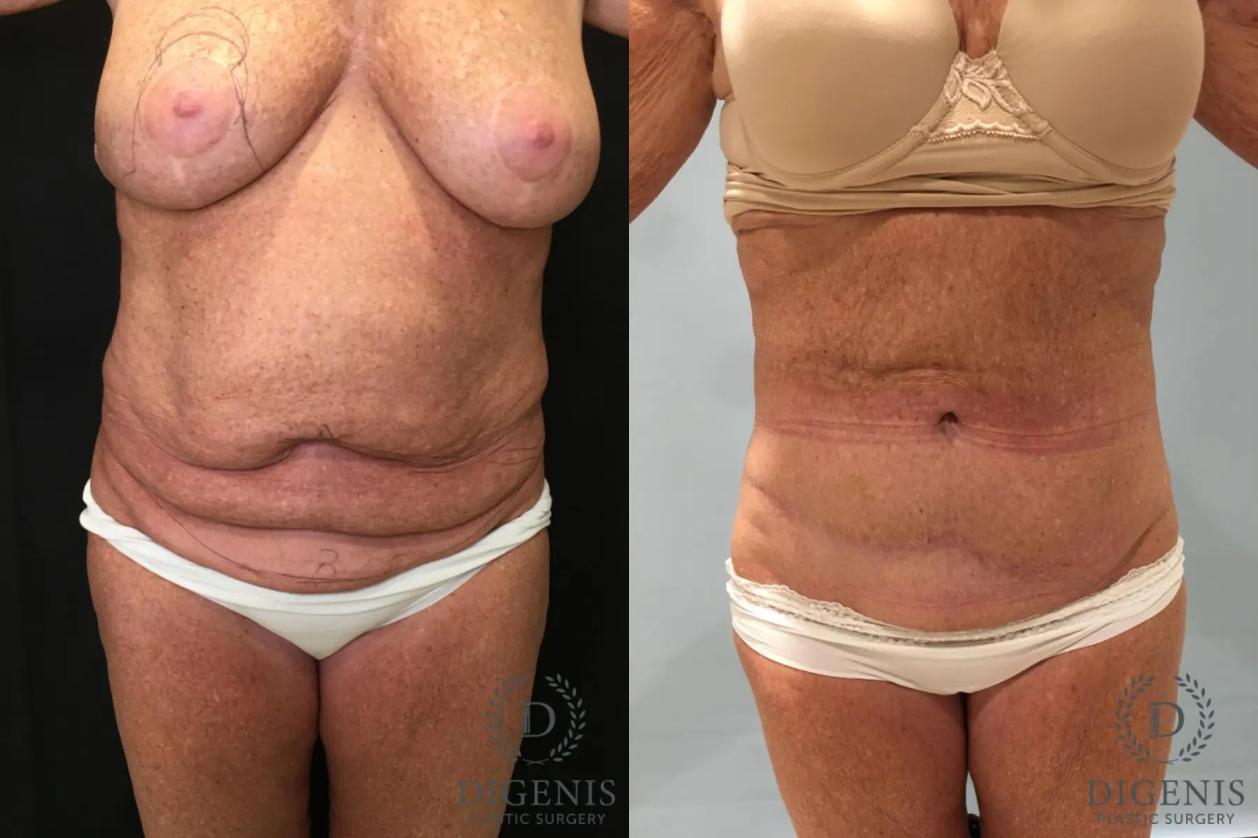 Abdominoplasty: Patient 25 - Before and After  